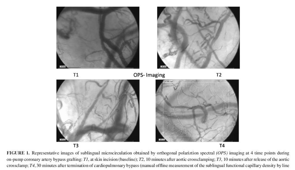 Beneficial recovery of microvascular organ perfusion for MiECC skin incision 10 min after aortic clamp 10 before
