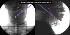 study. These cases represent complex geometry wherein implanted catheters were oblique and parallel to the imaging plane.