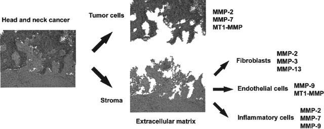 FIGURE 1. Head and neck cancer is composed of multiple cell types, each with different patterns of matrix metalloprotease (MMP) expression.