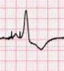 Output: None to the patient or pacemaker. Figure 2 Typical heart rhythm produced by a patient not requiring a pacer. Cardiachealth.org ecg-educator.blogspot.