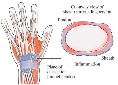 What is tendonitis and tenosynovitis? A tendon is a strong band of tissue that attaches a muscle to a bone and is capable of withstanding high levels of force.