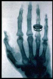 A Brief History of Radiation Wilhelm Roentgen discovered X- rays on November 8, 1895, while experimenting with a gas-filled cathode tube He noted an image of the