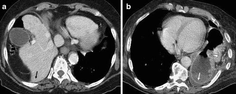 232 Emerg Radiol (2012) 19:225 235 Fig. 7 Dependent viscera sign. Two distinct cases. a A 62-year-old woman who sustained a blunt thoracoabdominal trauma after a fall from a bicycle 3 years before.