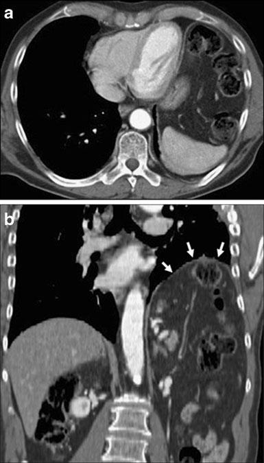 In the supine position, the liver and the abdominal fat lie against the posterior thoracic wall, obliterating the costophrenic sulcus (arrow). b A 38-year-old man who sustained a motorcycle collision.