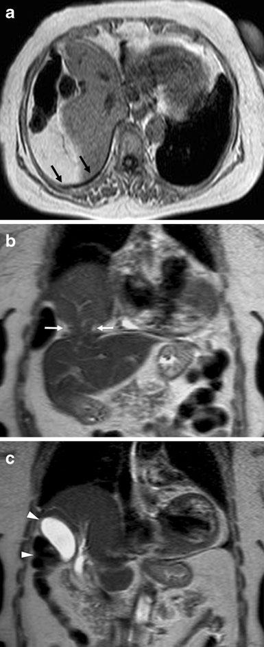 10 Dangling sign in right (a) and left (b) hemidiaphragmatic rupture. Two distinct cases of blunt abdominal trauma after car accidents.
