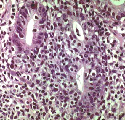 MALT lymphoma (Extranodal Marginal Zone B-Cell Lymphoma of Mucosa-Associated Lymphoid-Tissue ) HISTOLOGICAL FEATURES AND PHENOTYPE centrocyte-like cells (usually) lymphoepithelial lesions