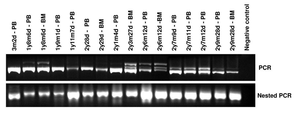 Screening for GATA1 mutations in newborns with Down syndrome 4635 Figure 2. Cytogenetic analysis from Down syndrome patient 2 with clonal alteration at BM aspirate.