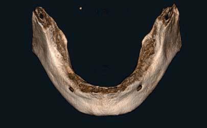 sensitivities and endodontic retreatment did not abate the problem, the CB3D scan can reveal