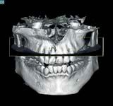 It is common to expect two roots and two canals in maxillary first premolars, but it is less