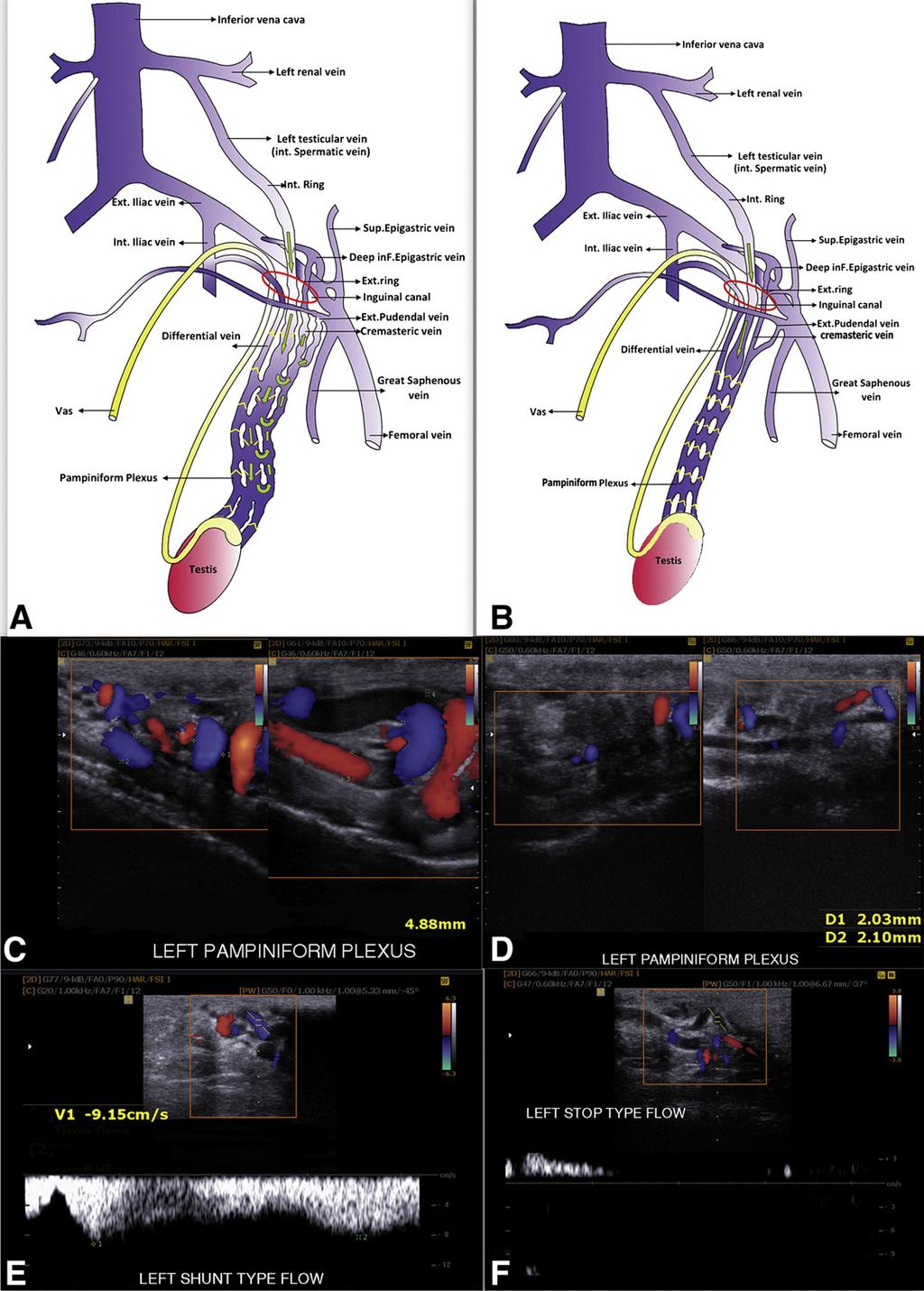 FIGURE 1 (A) Schematic anatomy of the shunt-type varicocele shows incompetent valves and shunting through communicating veins, whereas in (B) stop-type varicocele the reflux in the spermatic vein is