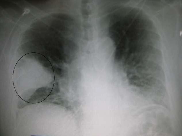 CHEST X-RAY OF