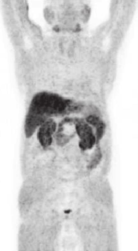 Case 2 Physiologic Uptake 3 Administration route Salivary glands Liver Kidney
