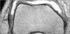CT-Arthrography Cartilage Fissure and Early