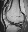 moderately well displayed Other structures (menisci, ligaments) can also be evaluated Fast