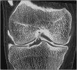 Fracture (Flake) Fracture More diffuse abnormal