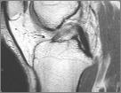 Osteochondral Impaction Old,