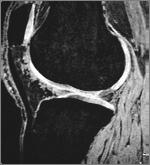 Osteochondral Fracture