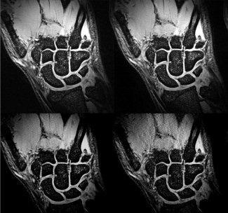 MRI of the wrist at 7 tesla using an