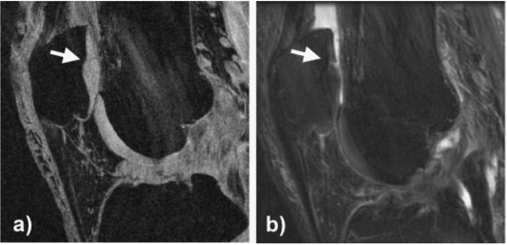 Conventional MRI (a) Sagittal fat saturated SPGR image of the knee in a patient with early OA and a