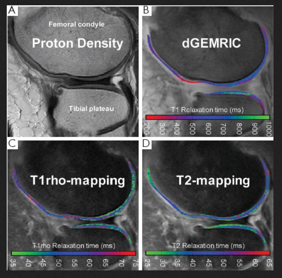 Exploring cartilage with MRI Morphology