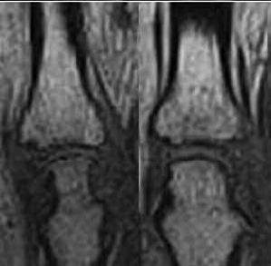 MRI investigations of joints Score related to the JSN