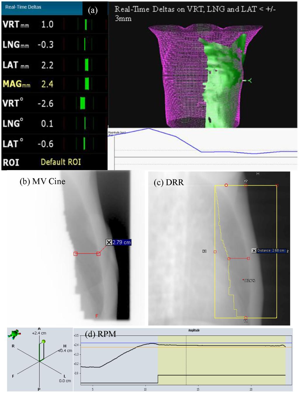 Surface Surrogate for Left Breast DIBH Treatment Figure 1. Displays of AlignRT system, MV Cine imaging, DRR, and the RPM system for treatments.