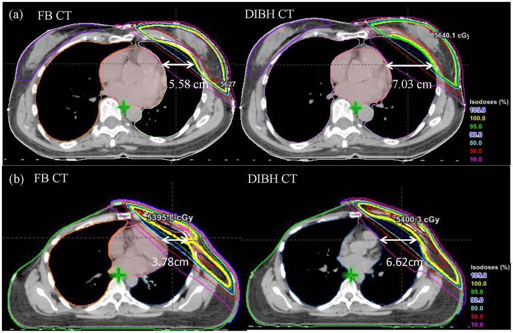 Figure 2. Anatomy and isodose comparisons for (a) the left breast and (b) the left CW patients (left: FB CT; right: DIBH CT).