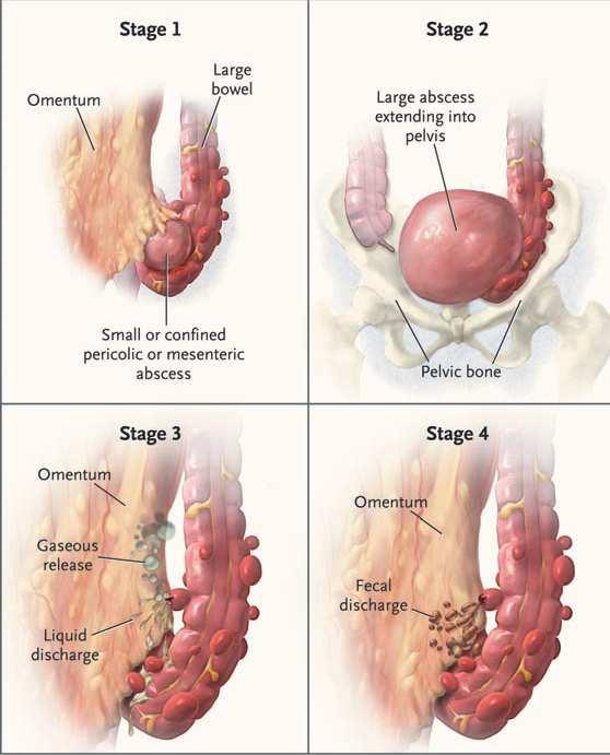 Staging The severity of diverticulitis is often graded with the use of Hinchey's