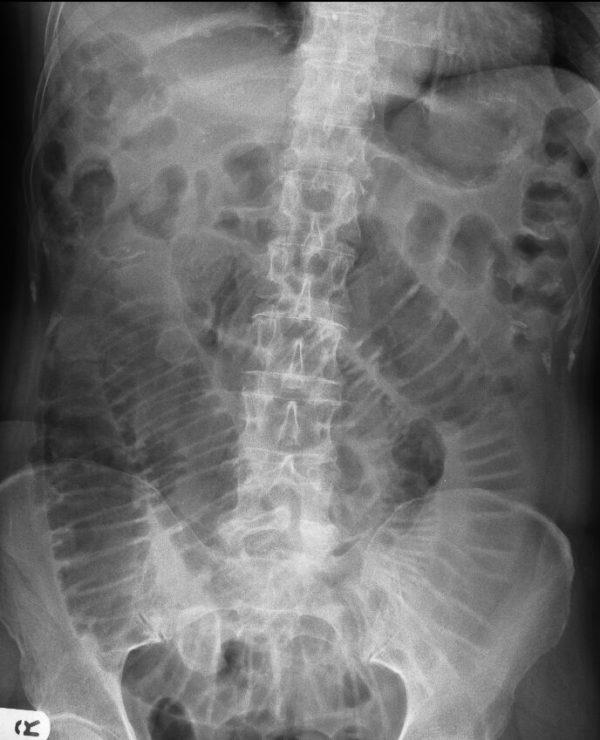 SMALL BOWEL OBSTRUCTION Small bowel obstruction can be visualised on an AXR as dilatation of the small bowel (>3cm).