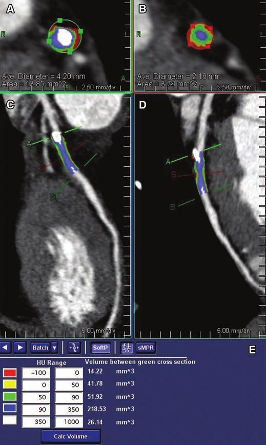 Bauer et al. both calcium scores were separately calculated for the right (RCA), left main, left anterior descending (LAD), and circumflex (LCX) coronary arteries.