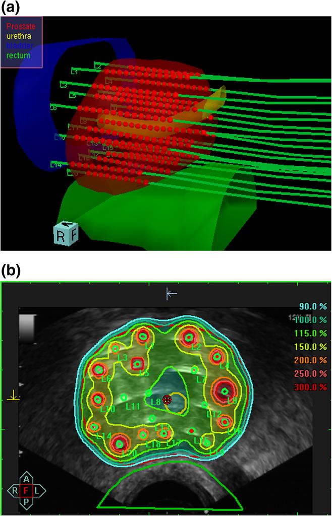 Tselis et al. Radiation Oncology 213, 8:115 Page 4 of 7 Figure 1 Intraoperative real-time treatment planning. (a) Threedimensional reconstruction of the prostate, organs at risk (i.e., rectum, urethra, bladder), in situ needles and the intraprostatic source dwell positions as calculated using SWIFT for the final treatment plan.