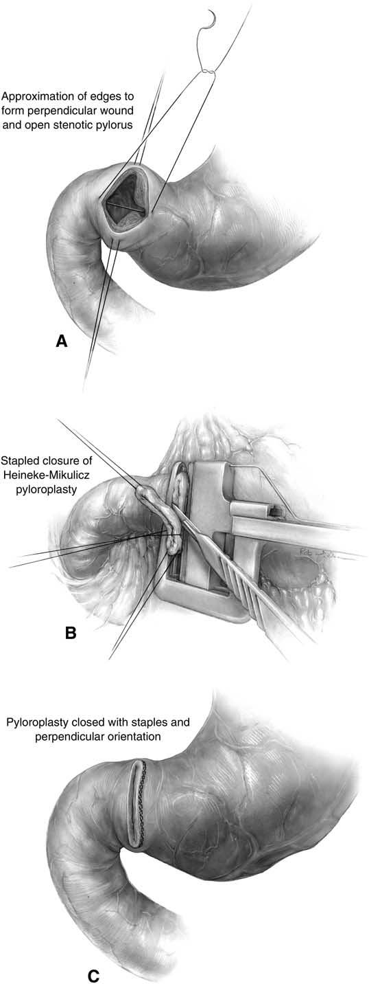 70 Söreide and Söreide onto the anterior wall of the gastroduodenostomy until a safe and well-approximated closure forms the anterior part of the pyloroplasty.