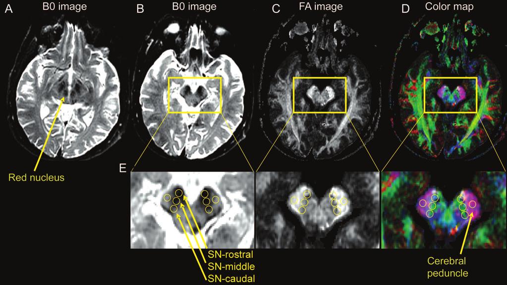 Figure 1 Procedure used to draw regions of interest in the substantia nigra (A) B0 image with the red nucleus and substantia nigra. This slice was first identified.