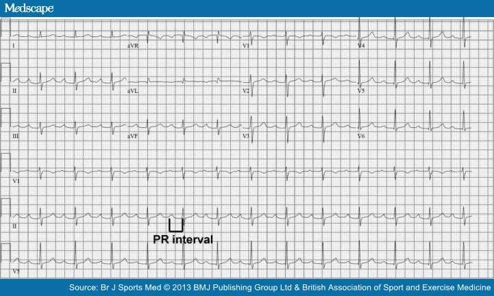 ECG shows first-degree AV block (PR interval >200 ms).
