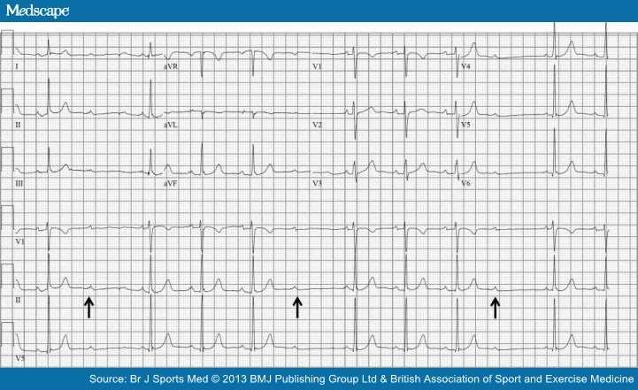 ECG shows Mobitz type I (Wenckebach) second-degree AV block demonstrated by progressively longer PR intervals until there is a non-conducted P wave (arrows) and no QRS complex.