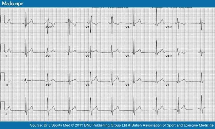 ECG demonstrates incomplete right bundle branch block (IRBBB) with rsr' pattern in V1 and QRS duration of <120 ms.