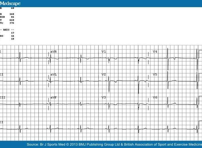 ECG demonstrates sinus bradycardia with a heart rate of 40 bpm.