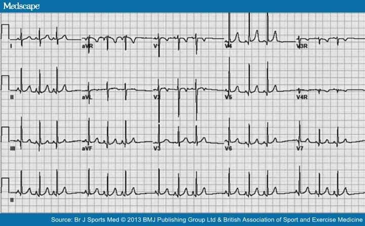 ECG demonstrates sinus arrhythmia. Note the irregular heart rate that varies with respiration.