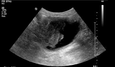 Figure 1 Figure 1: Ultrasound of the bladder