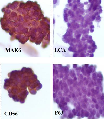 Figure 4 Figure 3: immunocytochemistry evaluation showed malignant cells with epithelial origin (MAK6 positive and LCA negative).