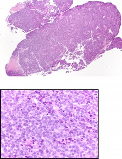 Figure 5 Figure 4: Hematoxylin and eosin staining of the biopsy specimen showed tumor composed of small cells with minimal cytoplasm and hyperchromatic nuclei with crowding, molding and overlap.