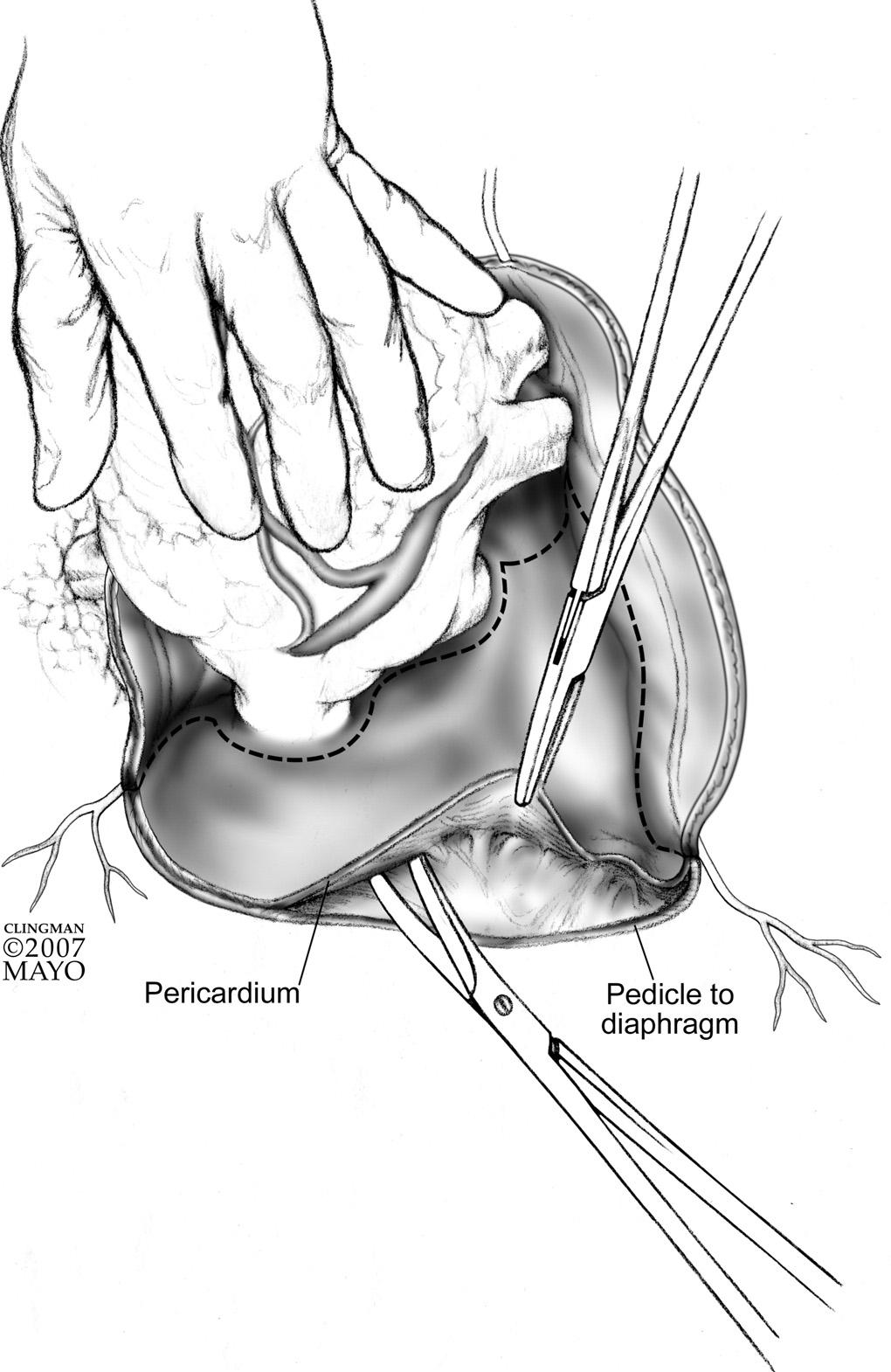 Pericardiectomy for constrictive or recurrent inflammatory pericarditis 11 Figure 9 Dissection then proceeds with removing the inferior pericardium off of the diaphragm.