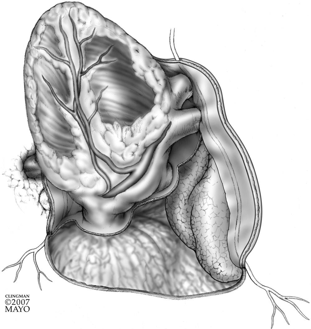 12 M.A. Villavicencio, J.A. Dearani, and T.M. Sundt, III Figure 10 The posterior pericardium (behind the left phrenic nerve) has been removed and the inferior pericardium (ie, pericardium adjacent to the diaphragm) has been removed.