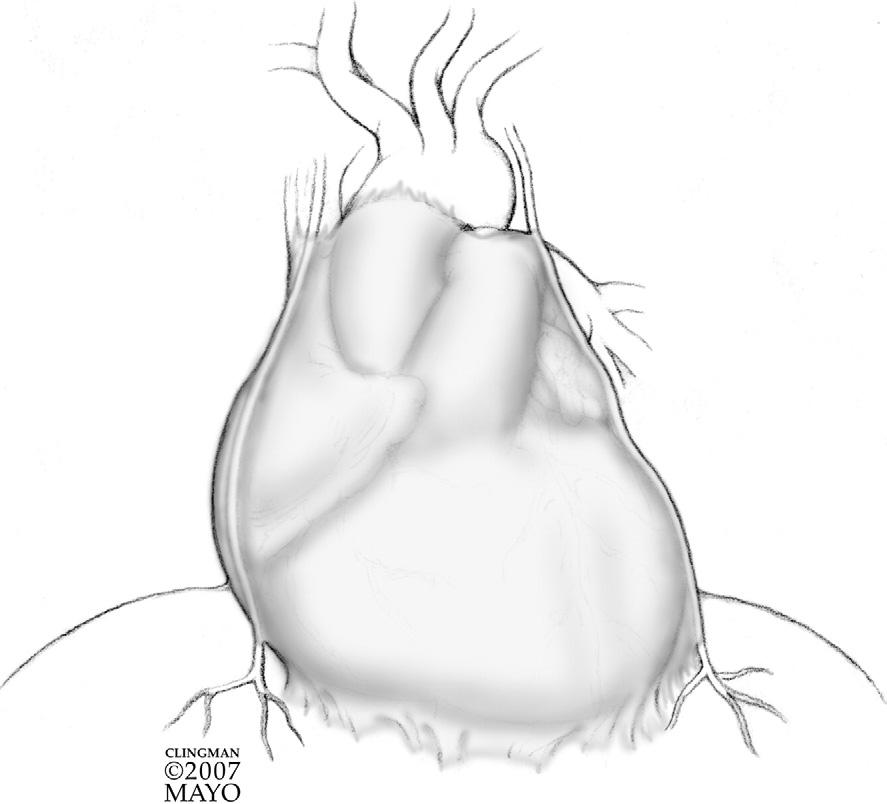 4 M.A. Villavicencio, J.A. Dearani, and T.M. Sundt, III Figure 2 This figure demonstrates the pericardium and its relationship to the great arteries, right atrium, and right ventricle.