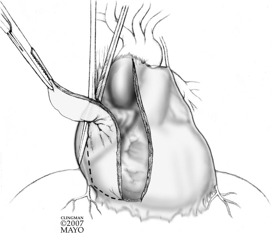 6 M.A. Villavicencio, J.A. Dearani, and T.M. Sundt, III Figure 4 The dissection proceeds laterally on the right side when pericardiectomy is performed for recurrent inflammatory pericarditis to