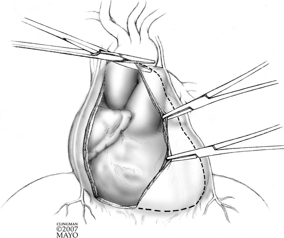 8 M.A. Villavicencio, J.A. Dearani, and T.M. Sundt, III Figure 6 The anterior pericardium is then removed sharply.