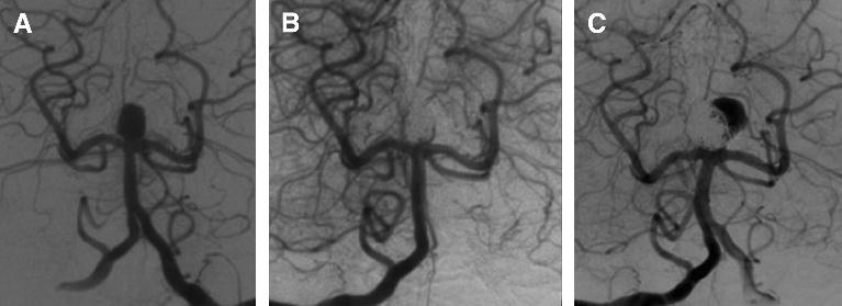 Tso et al Clinical Neurosurgery Volume 58, 2011 Reintervention Of the 29 patients who had interval recanalization after coiling, 18 patients had angiographic progression deemed concerning enough for