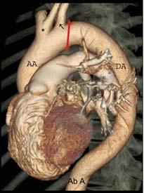 aortic syndrome, including: I. Aortic Dissection II. Intramural Hematoma III.
