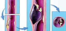 aorta Low density tissue surrounding