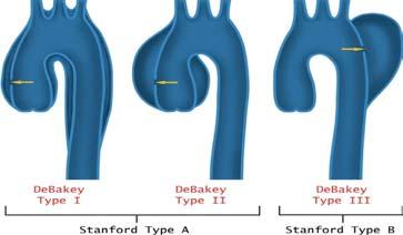 Aortic Dissection: classification Aortic